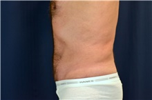Tummy Tuck After Photo by Michael Frederick, MD; Fort Lauderdale, FL - Case 40033