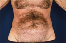Tummy Tuck Before Photo by Michael Frederick, MD; Fort Lauderdale, FL - Case 40033