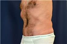 Tummy Tuck After Photo by Michael Frederick, MD; Fort Lauderdale, FL - Case 40033
