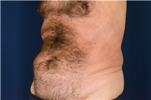 Tummy Tuck Before Photo by Michael Frederick, MD; Fort Lauderdale, FL - Case 40033