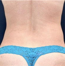 Tummy Tuck After Photo by Michael Frederick, MD; Fort Lauderdale, FL - Case 40034