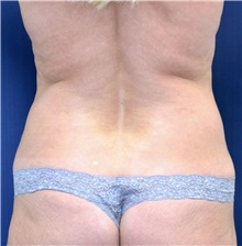 Tummy Tuck Before Photo by Michael Frederick, MD; Fort Lauderdale, FL - Case 40034