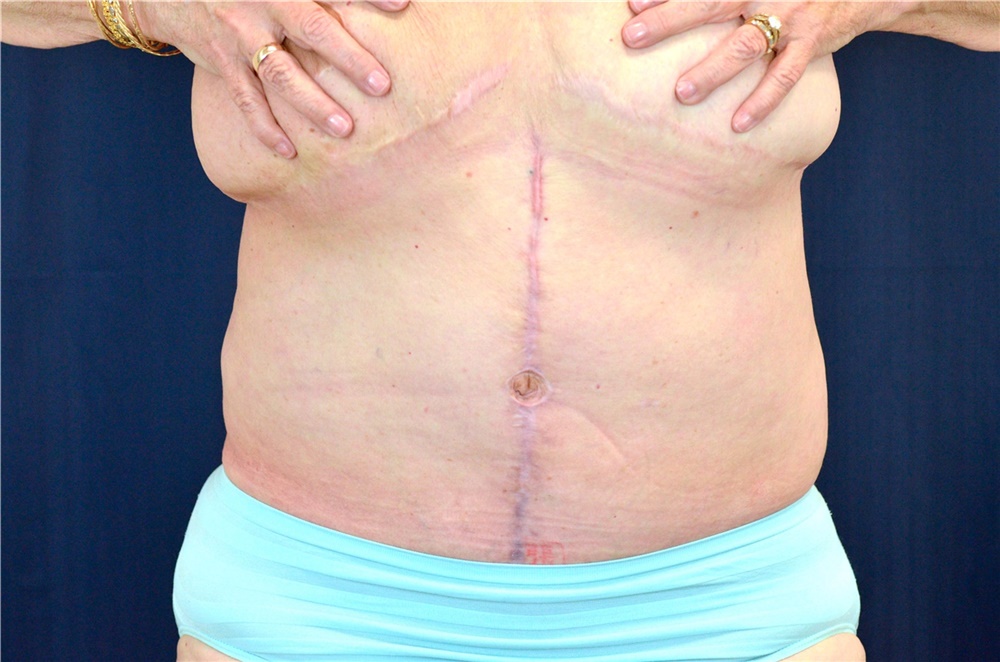 Tummy Tuck Before and After Photos by Michael Frederick, MD; Fort
