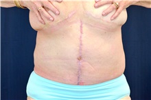 Tummy Tuck After Photo by Michael Frederick, MD; Fort Lauderdale, FL - Case 40036