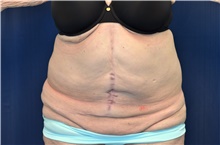 Tummy Tuck Before Photo by Michael Frederick, MD; Fort Lauderdale, FL - Case 40036