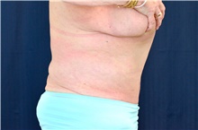 Tummy Tuck After Photo by Michael Frederick, MD; Fort Lauderdale, FL - Case 40036
