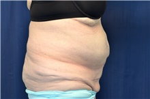 Tummy Tuck Before Photo by Michael Frederick, MD; Fort Lauderdale, FL - Case 40036