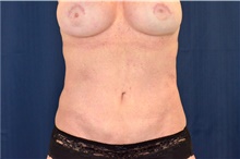 Tummy Tuck After Photo by Michael Frederick, MD; Fort Lauderdale, FL - Case 40038