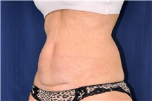 Tummy Tuck Before Photo by Michael Frederick, MD; Fort Lauderdale, FL - Case 40038