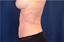 Tummy Tuck After Photo by Michael Frederick, MD; Fort Lauderdale, FL - Case 40038