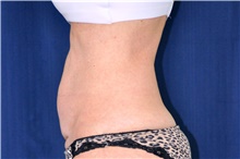 Tummy Tuck Before Photo by Michael Frederick, MD; Fort Lauderdale, FL - Case 40038