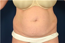 Tummy Tuck Before Photo by Michael Frederick, MD; Fort Lauderdale, FL - Case 40039