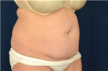 Tummy Tuck Before Photo by Michael Frederick, MD; Fort Lauderdale, FL - Case 40039