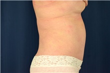 Tummy Tuck After Photo by Michael Frederick, MD; Fort Lauderdale, FL - Case 40039