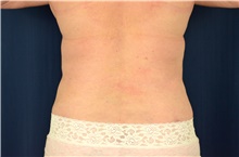 Tummy Tuck After Photo by Michael Frederick, MD; Fort Lauderdale, FL - Case 40039