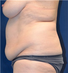 Tummy Tuck Before Photo by Michael Frederick, MD; Fort Lauderdale, FL - Case 40040