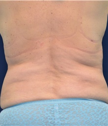 Tummy Tuck After Photo by Michael Frederick, MD; Fort Lauderdale, FL - Case 40040