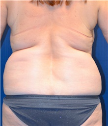 Tummy Tuck Before Photo by Michael Frederick, MD; Fort Lauderdale, FL - Case 40040
