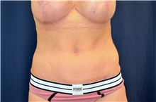 Tummy Tuck After Photo by Michael Frederick, MD; Fort Lauderdale, FL - Case 40041