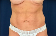 Tummy Tuck Before Photo by Michael Frederick, MD; Fort Lauderdale, FL - Case 40041