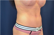 Tummy Tuck After Photo by Michael Frederick, MD; Fort Lauderdale, FL - Case 40041