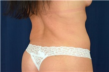 Tummy Tuck Before Photo by Michael Frederick, MD; Fort Lauderdale, FL - Case 40041