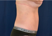 Tummy Tuck After Photo by Michael Frederick, MD; Fort Lauderdale, FL - Case 40043