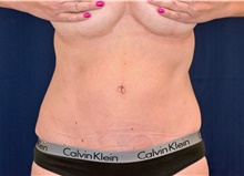 Tummy Tuck After Photo by Michael Frederick, MD; Fort Lauderdale, FL - Case 40043