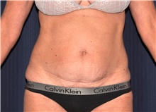 Tummy Tuck Before Photo by Michael Frederick, MD; Fort Lauderdale, FL - Case 40043