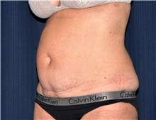 Tummy Tuck Before Photo by Michael Frederick, MD; Fort Lauderdale, FL - Case 40043