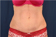 Tummy Tuck After Photo by Michael Frederick, MD; Fort Lauderdale, FL - Case 40044