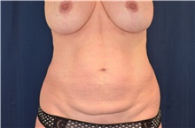 Tummy Tuck Before Photo by Michael Frederick, MD; Fort Lauderdale, FL - Case 40044