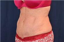 Tummy Tuck After Photo by Michael Frederick, MD; Fort Lauderdale, FL - Case 40044