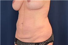 Tummy Tuck Before Photo by Michael Frederick, MD; Fort Lauderdale, FL - Case 40044