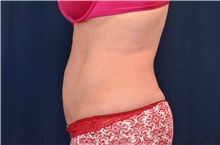 Tummy Tuck After Photo by Michael Frederick, MD; Fort Lauderdale, FL - Case 40044