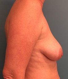 Breast Augmentation Before Photo by Tiffany Ballard, MD; Ann Arbor, MI - Case 50397