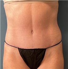 Tummy Tuck After Photo by Tiffany Ballard, MD; Ann Arbor, MI - Case 50392