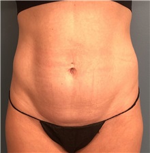 Tummy Tuck Before Photo by Tiffany Ballard, MD; Ann Arbor, MI - Case 50392