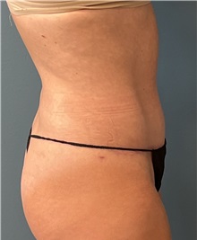 Tummy Tuck After Photo by Tiffany Ballard, MD; Ann Arbor, MI - Case 50392
