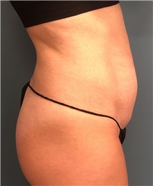 Tummy Tuck Before Photo by Tiffany Ballard, MD; Ann Arbor, MI - Case 50392