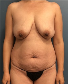 Mommy Makeover Before Photo by Tiffany Ballard, MD; Ann Arbor, MI - Case 50393