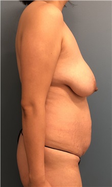 Mommy Makeover Before Photo by Tiffany Ballard, MD; Ann Arbor, MI - Case 50393