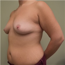 Breast Augmentation Before Photo by Babis Rammos, MD, FACS; Peoria, IL - Case 33966