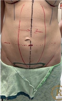 Tummy Tuck Before Photo by Babis Rammos, MD, FACS; Peoria, IL - Case 45124