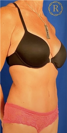 Tummy Tuck After Photo by Babis Rammos, MD, FACS; Peoria, IL - Case 45125