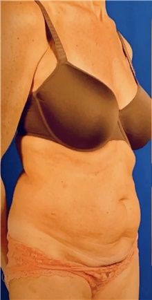 Tummy Tuck Before Photo by Babis Rammos, MD, FACS; Peoria, IL - Case 45125