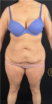 Tummy Tuck Before Photo by Babis Rammos, MD, FACS; Peoria, IL - Case 47143