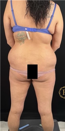 Body Lift Before Photo by Babis Rammos, MD, FACS; Peoria, IL - Case 47144