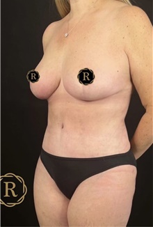 Mommy Makeover After Photo by Babis Rammos, MD, FACS; Peoria, IL - Case 47145