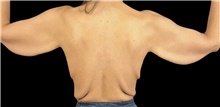 Body Lift Before Photo by Babis Rammos, MD, FACS; Peoria, IL - Case 47167